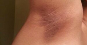 Jak odstranit tmavé skvrny v podpaží a rozkroku.