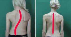 Skolióza a bolesti zad s ní spojené. Poradíme vám cviky, po kterých se budete cítit lépe.