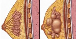 Nemusíte jít pod skalpel: Vylečte všechny cysty s tímto receptem