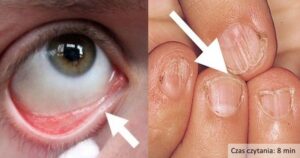 Nedostatek železa: podívejte se na příčiny a příznaky