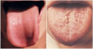 Dávejte svému jazyku zvýšenou péči, protože vám může ukázat spoustu skrytých zdravotních problémů.