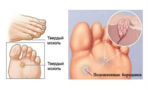 Nejlepší způsoby, jak se zbavit mozolů a bradavic na nohou