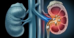 Vyhněte se operaci: Léčivá bylinka, což rozpouští ledvinové kameny