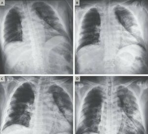 Takhle koronavirus ničí plíce: Bílé skvrny způsobují bolest a ztěžují dýchání