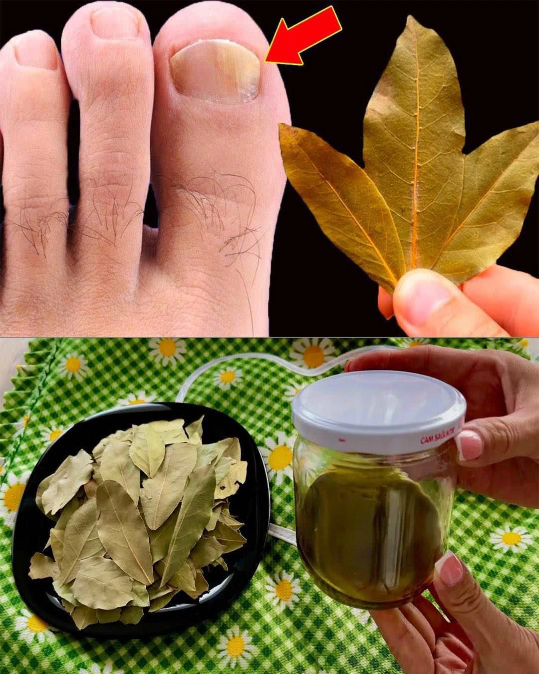 Prírodná liečba plesne nechtov pomocou bobkového listu: jednoduchý domáci postup, ktorý stojí za vyskúšanie