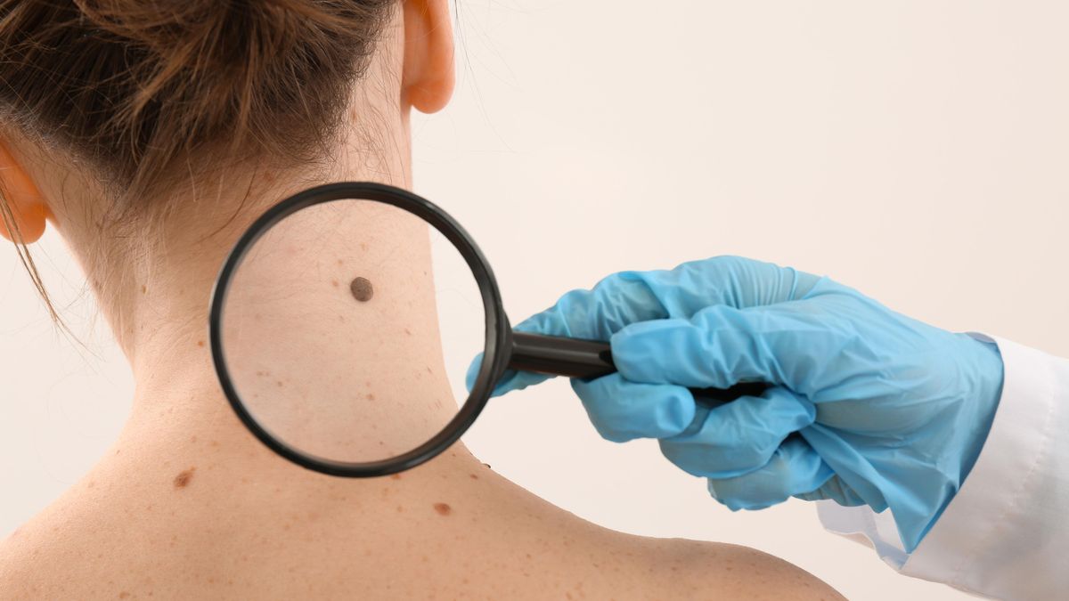 Kontrola znamének na kůži u dermatologa