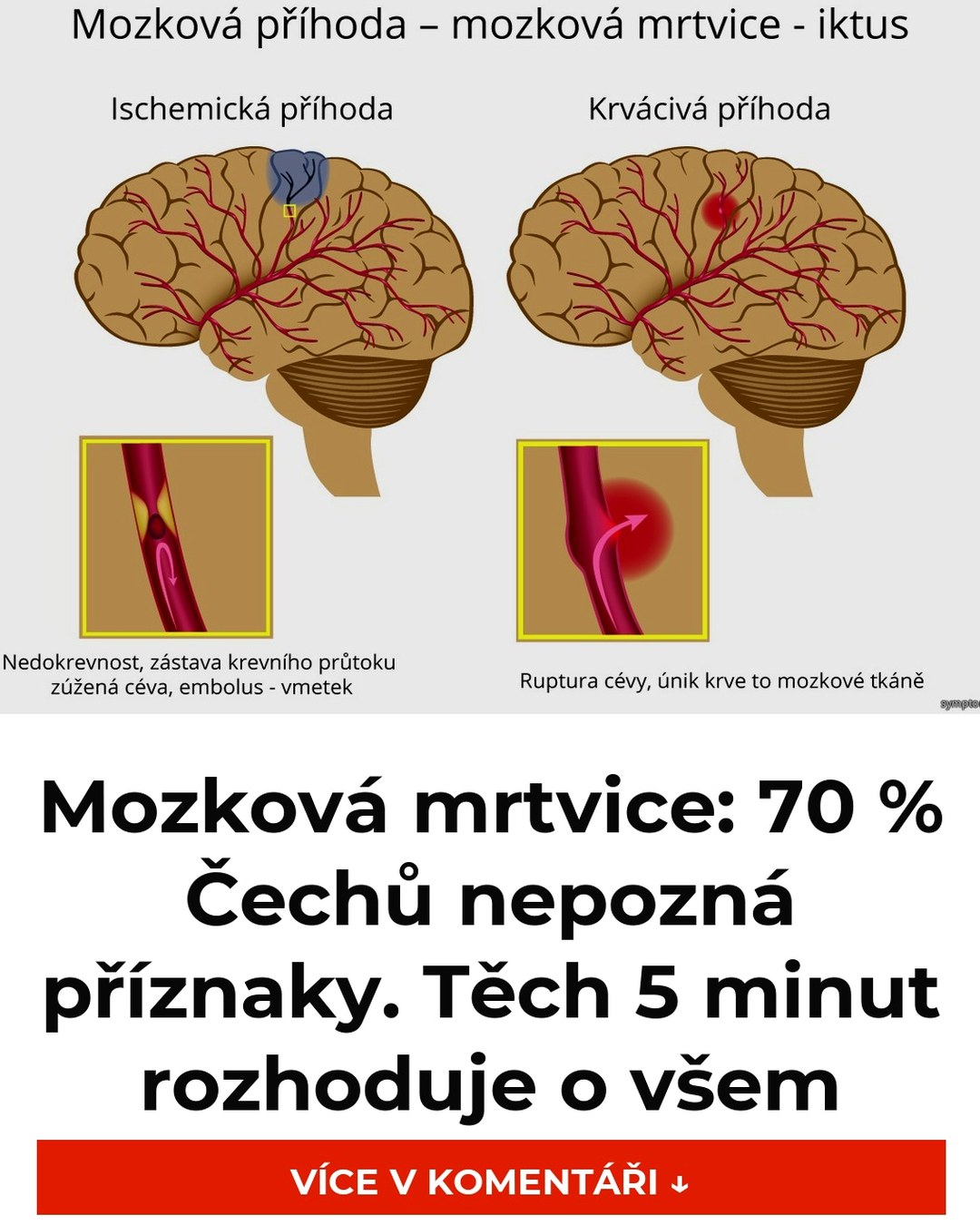 Mozková mrtvice: 70 % Čechů nepozná příznaky. Těch 5 minut rozhoduje o všem