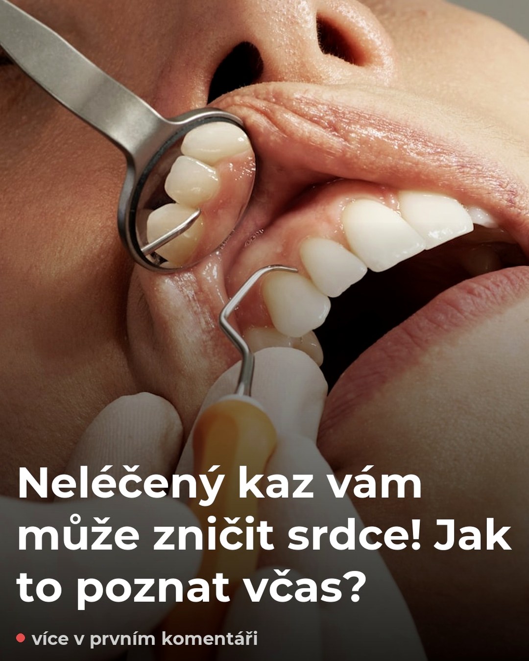 Neléčený kaz vám může zničit srdce! Jak to poznat včas?