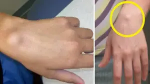 Ganglionová cysta: Co to je, kdy vyhledat lékaře a co nikdy nedělat