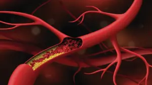 Cholesterol „v normě" může ničit cévy. Co skutečně rozhoduje o riziku infarktu?