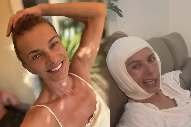 Alice Bendová po faceliftu za statisíce: výsledek operace tváře je konečně jasný