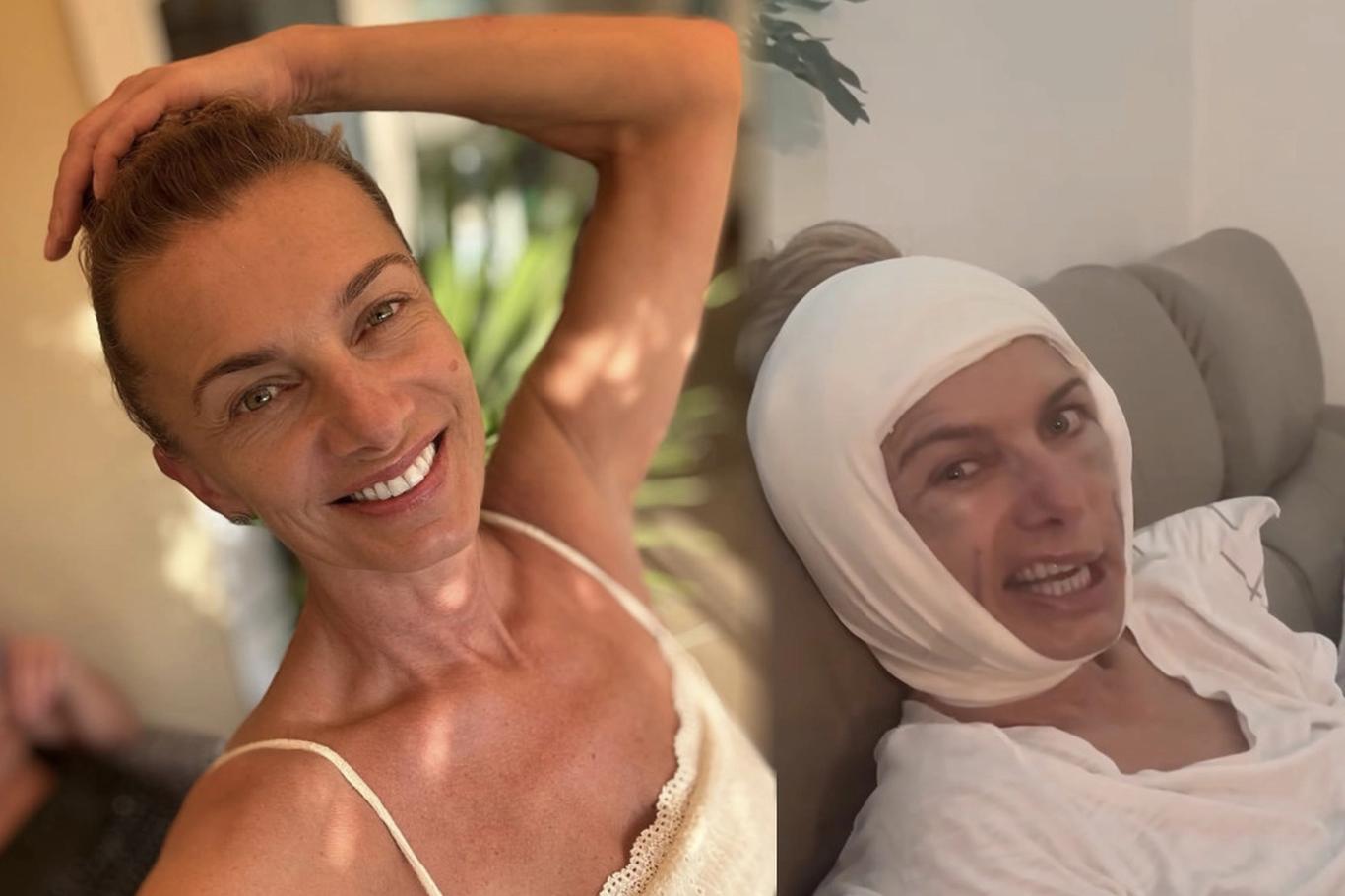 Alice Bendová podstoupila facelift za statisíce: takto vypadá po operaci tváře