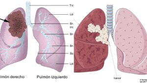 Rakovina plic roky roste bez příznaků! Tři věci, které vám mohou zachránit život